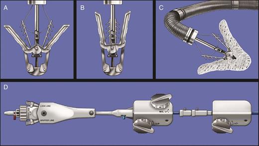 The MitraClip system. (A) The partially open MitraClip device is shown without its fabric covering. A fine wire runs through the barbed ‘grippers’, which is used to raise the grippers. (B) The device in closed configuration. (C) The MitraClip is attached to the clip delivery system, which protrudes from the steerable guide catheter. (D) Control knobs allow deflection of the guide and clip delivery system to steer the system through the left atrium and position the MitraClip above the mitral orifice. From Feldman and Young44.