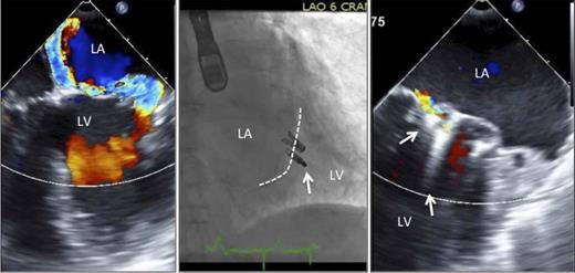 The left panel shows a two-dimensional echo frame with severe mitral regurgitation. The middle frame shows two MitraClip devices placed on the mitral leaflets (arrow). The dotted line represents the line of mitral leaflet coaptation. The left panel shows the clips (arrows) and there is no residual mitral regurgitation. LA, left atrium; LV, left ventricle.