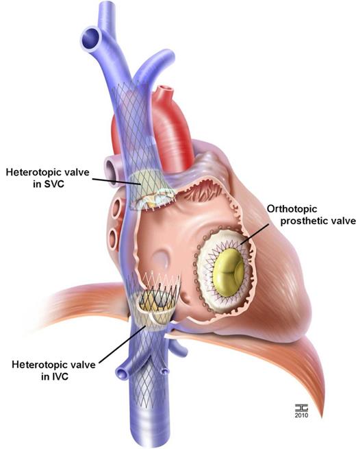 Concepts of transcatheter tricuspid valve replacement. Tric Valve technology: vena cava superior heterotopic valve and vena cava inferior valve, notice that the inferior vena cava valve does not obstruct liver venea inflow. Orthotopic tricuspid valve implantation has never been successful.