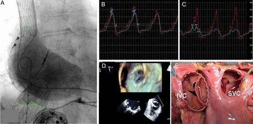 Caval valve implantation. (A) Position of self-expandable valves in superior and inferior vena cava. Note the valve leaflets marked by angiography. (B and C) Pressure measurement confirms a reduction of v-wave and mean pressure in inferior vena cava pressure from 32 to 23 mmHg and 24 to 19 mmHg, respectively. (D) Device function is observed in transoesophageal echocardiography. (E) Macroscopic specimen demonstrating the device position in the superior vena cava and inferior vena cava.