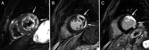 (A) Short-axis T2-weighted image at baseline shows high signal intensity in the left ventricular lateral wall corresponding to the area-at-risk (arrows). Central hypointense area corresponds with intramyocardial haemorrhage (asterisk). (B) Short-axis late gadolinium enhancement image at baseline shows high signal intensity in the left ventricular lateral wall corresponding to an extensive area of transmural necrosis (arrows). Central hypointense area corresponds with microvascular obstruction (asterisk). (C) Short-axis late gadolinium enhancement image at follow-up shows important wall thinning and remodelling of the lateral wall (arrows).