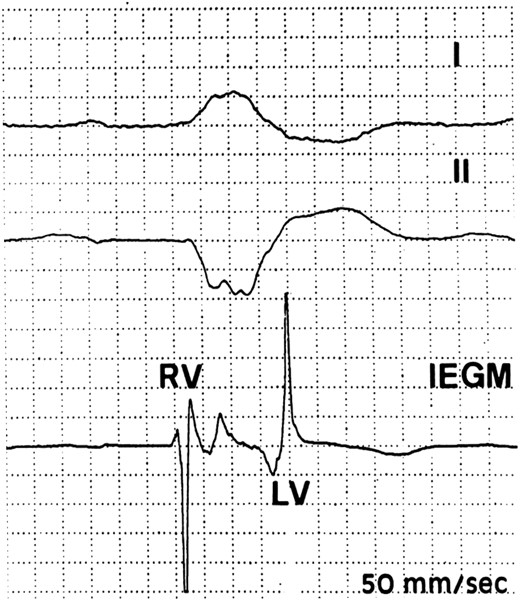 Perioperative identification of earliest and latest activation sites during spontaneous conduction. In this patient with typical left bundle branch block, the earliest site was in the right ventricular mid-septum and the latest at the left ventricular base in the proximal segment of a posterolateral vein. The 190 ms interventricular conduction delay was longer than the 175 ms QRS duration on the surface electrocardiogram.