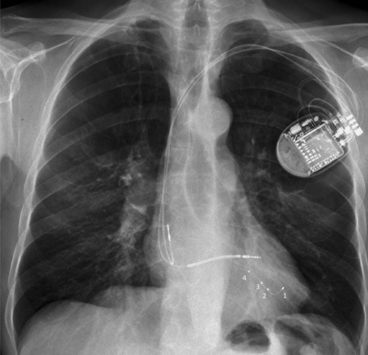 Chest X-ray in antero-posterior view showing a quadripolar LV lead with the distal tip placed at the apex to provide more lead stability. To prevent apical pacing, left ventricular pacing can be delivered at dipoles 2–3 or 3–4 closer to the left ventricular base, or by using other pacing vectors with the right ventricular coil depending on pacing thresholds and the acute haemodynamic response when assessed.