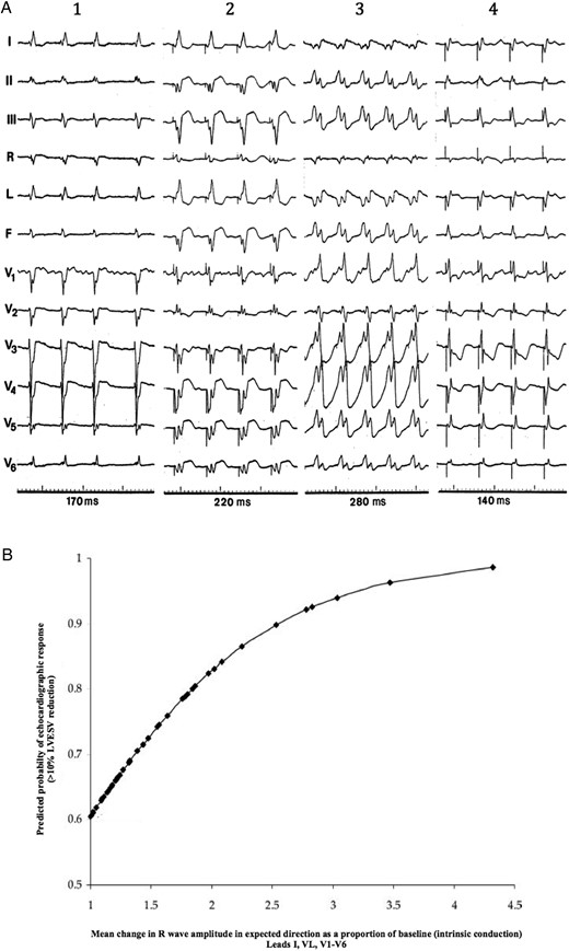 (A) Typical electrocardiogram changes after cardiac resynchronization therapy in a hyper-responder patient. Compared with intrinsic conduction (1), right ventricular pacing (2) and left ventricular pacing (3) biventricular pacing (4) causes a significant shortening of QRS simultaneously emerge a dominant-R wave in lead V1, both signs indicating optimal fusion between left ventricular pre-excitation and intrinsic conduction. (B) Correlation between changes in R-wave amplitude in lead V1 after cardiac resynchronization therapy, and the probability of echocardiographic response defined as >10% reduction in left ventricular endsystolic volume at 6 months. Greater changes in R-wave amplitude after cardiac resynchronization therapy, indicative of wavefront fusion, predict higher probability of response. From Sweeney et al.60 Reproduced with permission of authors and editor.