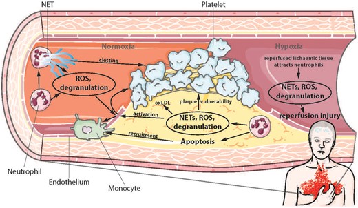 Effects of neutrophils in atherosclerosis, thrombosis, and ischaemia-reperfusion injury. NETs, neutrophil extracellular traps; ROS, reactive oxygen species; oxLDL, oxidised low-density lipoprotein.