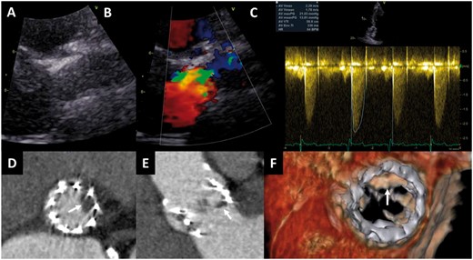 Mismatch between haemodynamics of transcatheter aortic valve on transthoracic echocardiography and anatomic findings on multidetector row computed tomography. An 85-year-old female treated with a 23 mm SAPIEN valve who underwent transthoracic echocardiography and multidetector row computed tomography at 2 months follow-up. The patient was asymptomatic. Echocardiography (parasternal long-axis view) showed a normal aspect of the valve leaflets (A), and mild turbulent flow (colour Doppler, B), with mean and peak gradients of 13 and 21 mmHg, and calculated aortic valve area of 1.3 cm2 (C). On multidetector row computed tomography, the reconstructed short-axis view (D) and the sagittal view (E) show hypoattenuated leaflet thickening of the left coronary cusp; four-dimensional volume rendering of the valve shows the thickening of the leaflet with restrictive motion in systole (F).