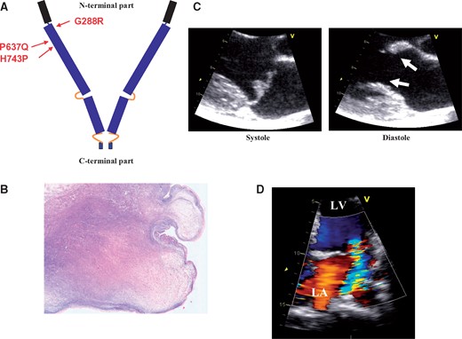 (A) Filamin-A protein with the C-terminal and N-terminal parts, and the three missense mutations localization, (B) microphotograph of a mitral leaflet piece (FLNA-G288R, Family 4, resection during mitral valve repair) showing a nodular thickened valve with myxomatous degeneration (colloidal iron, original magnification × 20), (C) typical aspect in echocardiography of the paradoxical association of mitral valve prolapse (systole) and restrictive motion in diastole (doming, arrows) in a P637Q patient in the parasternal long-axis view, (D) with moderate MR in the apical view.