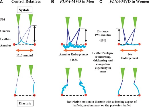 Schematic of MV apparatus morphology averaged in systole (top) and diastole (bottom) (A) in adult controls, (B) in FLNA-MVD (FLNA+) men and (C) in FLNA-MVD women. In men (B) mitral annulus is 25% larger, mitral leaflets are thickened, redundant, elongated, and prolapsed in systole (top). In addition the distance between papillary muscles tip and mitral annulus line (symbolized by the double black arrow) is reduced by 20%. In diastole (bottom), mitral leaflets motion is limited with a doming aspect. In women (C) MV apparatus changes are moderate. PM, papillary muscle; FLNA, Filamin-A; MVD, mitral valve dystrophy.