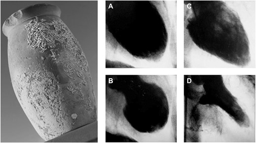 Historical Japanese octopus trap (left). Courtesy of Dr Templin, University Hospital Zurich, Zurich, Switzerland. Left ventriculogram of the first reported case of takotsubo syndrome. Diastole (A) and systole (B) during the acute phase of takotsubo syndrome. Recovery of left ventricular wall motion abnormality two weeks after the event (C and D). Courtesy of Dr Dote, Hiroshima City Asa Hospital, Hiroshima, Japan.