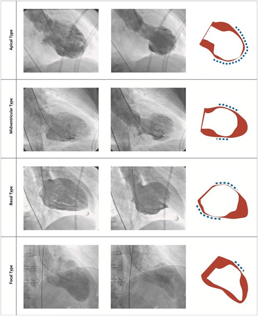 The four different types of takotsubo syndrome during diastole (left column) and systole (middle column). The right column depicts diastole in red and systole in white. The blue dashed lines demonstrate the region of the wall motion abnormality. Reprinted and modified with permission from Templin et al. 16