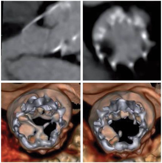 Portico valve with thick layer of hypo-attenuated leaflet thickening causing a severe reduction in leaflet motion (hypo-attenuation affecting motion). Top left panel: long axis multiplanar reconstruction in diastole; top right panel: axial multiplanar reconstruction diastole; Bottom left: diastolic volume rendering; bottom right: systolic volume rendering. Reproduced with permission from Sondergaard et al.  37