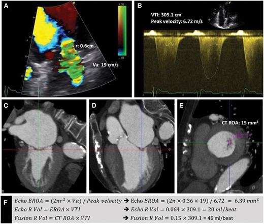 Integration of the Doppler echocardiography and computed tomography data to quantify mitral regurgitant volume. By echocardiography, the proximal isovelocity surface area method was used for the assessment of the effective regurgitant orifice area of the mitral regurgitation.(Panels A, B, and F) The velocity time integral of the magnetic resonance jet was assessed on the continuous wave Doppler images (Panel B). By aligning the multiplanar reformation planes on the multi-detector computed tomography data, a double oblique transverse plane parallel to the narrowest part of the mitral regurgitant orifice was reconstructed. The anatomical mitral regurgitant orifice area was measured by planimetry at this level (Panels C–E). The echocardiography and integrated regurgitant volume of magnetic resonance were assessed by multiplying the echocardiographic effective regurgitant orifice area and the multi-detector computed tomography derived mitral regurgitant orifice area with the velocity time integral, respectively (Panel F). Reproduced with permission from van Rosendael et al.  42 VTI, velocity time integral; CT, computed tomography; ROA, regurgitant orifice area; RVol, regurgitant volume; EROA, effective regurgitant orifice area.