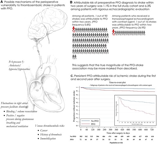 (A) Mechanisms of perioperative thromboembolic stroke in patients with PFO. (B) PFO-attributable risks of stroke within 2 years in the full study cohort and the cohort which received a transoesophageal echocardiogram with contrast agent. (C) Time-to-event plot for patients with PFO (red) and without PFO (blue) in subgroup of 658 patients who received a TOE with contrast agent (see Figure 3B).