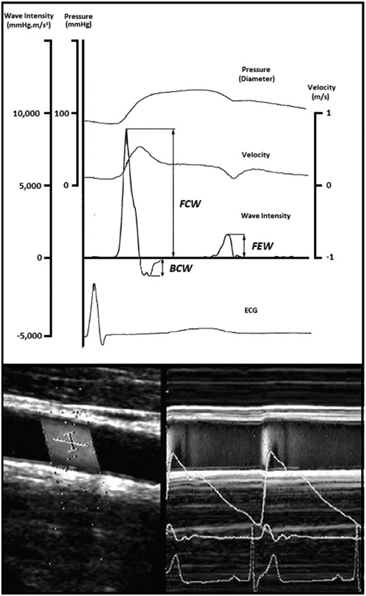 Representative image of a carotid wave intensity measurement performed using Doppler ultrasound. Representative trace showing output of carotid wave intensity analysis calculated from simultaneous non-invasive ultrasound measures of blood velocity (bottom left) and vessel diameter (bottom right). BCW, backwards compression wave; ECG, electrocardiogram; FCW, forward compression wave; FEW, forward expansion wave.