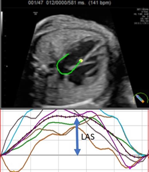 Fetal left atrial strain