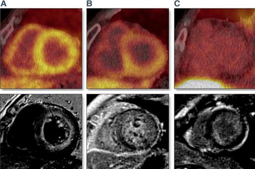 11-C Pittsburgh B PET imaging
