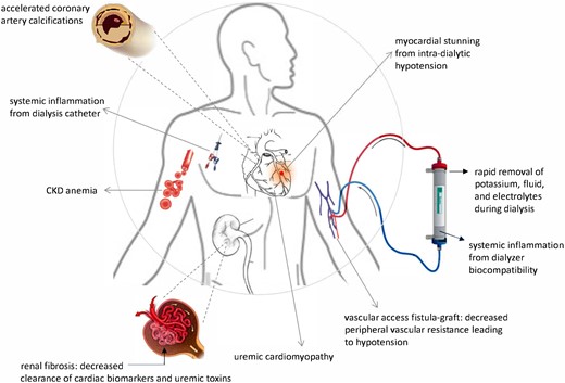 The mechanisms of cardiovascular disease shift when dialysis starts. (from Chan K, Moe SM, Saran R, Libby P. The cardiovascular-dialysis nexus: the transition to dialysis is a treacherous time for the heart. See pages 1244–1253)