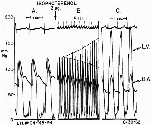 Provocation of obstruction in a patient with left ventricular hypertrophy without obstruction catheterized by the author in 1962. (A) Baseline pressure; (B) 16 cardiac cycles following isoproterenol bolus; dashed lines show increases in left ventricle and reductions in brachial artery systolic pressures. (C) Maximal effect = 90 mmHg gradient. B.A., brachial artery; L.V., left ventricle. Reproduced from Ref.2