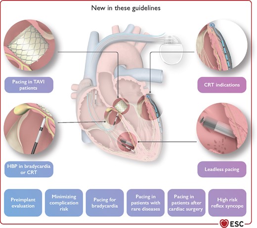 The 2021 ESC Guidelines on cardiac pacing and CRT present new and updated recommendations for these treatments in relevant patient populations.