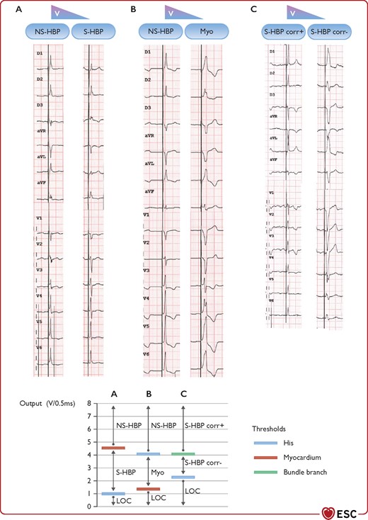 Three patients with different types of transitions in QRS morphology with His bundle pacing and decrementing pacing output. BBB = bundle branch block; Corr± = with/without correction of bundle branch block; LBBB = left bundle branch block; LOC = loss of capture; Myo = myocardium; NSHBP = non-selective His bundle pacing; S-HBP = selective His bundle pacing. (A) Non-selective to selective His capture. Note the presence of a ‘pseudo-delta’ wave with non-selective capture and an isoelectric interval after the pacing spike with selective capture. (B) Non-selective His capture to myocardial capture only. (C) Selective His capture with correction of BBB to selective His capture with LBBB. Note: the graph on the right of the panel shows a schematic representation of the different thresholds in the three instances.