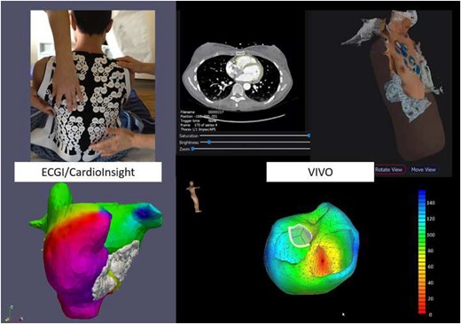 Left panel: Example of non-invasive simultaneous mapping of atrial fibrillation of both the right and left atrium using the electrocardiogram imaging technology. Several mechanisms occur in various areas of the atria simultaneously and thereby maintain atrial fibrillation. Right panel: Example of non-invasive simultaneous mapping of ventricular ectopy using the view into ventricular onset technology.