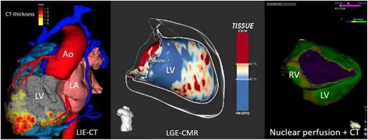 Left panel: 3D image information from computed tomography and myocardial thickness in a patient with coronary artery disease and apical scar after myocardial infarction. Middle panel: Image information of late gadolinium enhancement from cardiac magnetic resonance imaging of the left ventricle with identification of the potentially arrhythmogenic channels within the scar responsible for ventricular re-entrant tachycardia. Right panel: Example of perfusion information from functional nuclear imaging superimposed on a contrast computed tomography scan in a patient with arrhythmogenic right ventricular disease. Ao, aorta; CMR, cardiac magnetic resonance; LA, left atrium; LGE, late gadolinium enhancement; LV, left ventricle; RV, right ventricle.
