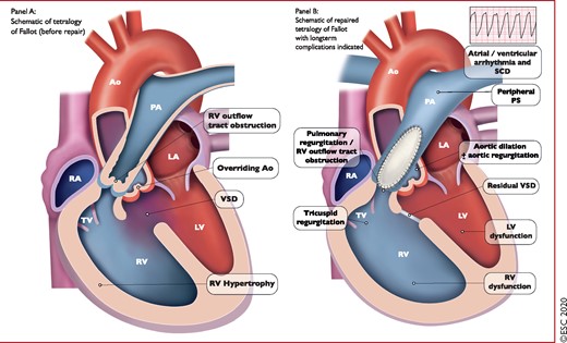 Management of repaired tetralogy of Fallot: long-term complications to address during follow-up. Ao = aorta; LV = left ventricle; RV = right ventricle; PA = Pulmonary artery; TV = tricuspid valve; RA = right atrium; RV = right ventricular; LA = left atrium; PA = pulmonary artery; PS = pulmonary stenosis; SCD = sudden cardiac death; VSD = ventricular septal defect.