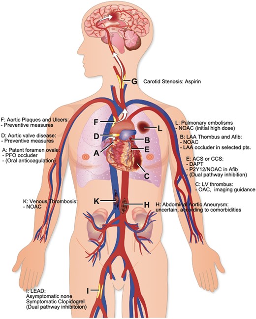 Sites of intravascular thrombus formation and/or embolization in the arterial and venous circulation. ACS, acute coronary syndrome; CCS, chronic coronary syndrome; DAPT, dual antiplatelet therapy; LAA, left atrial appendage; LEAD, lower extremity arterial disease; LV, left ventricular; NOAC, novel oral anticoagulant; PFO, patent foramen ovale.