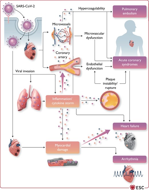 Cardiovascular involvement in COVID-19—key manifestations and hypothetical mechanisms. SARS-CoV-2 anchors on transmembrane angiotensin-converting enzyme 2 to enter the host cells including type 2 pneumocytes, macrophages, endothelial cells, pericytes, and cardiac myocytes, leading to inflammation and multiorgan failure. In particular, the infection of endothelial cells or pericytes could lead to severe microvascular and macrovascular dysfunction. Furthermore, in conjunction with the immune over-reactivity, it can potentially destabilize atherosclerotic plaques and explain the development of the acute coronary syndrome. Infection of the respiratory tract, particularly of type 2 pneumocytes, by severe acute respiratory syndrome coronavirus 2 is manifested by the progression of systemic inflammation and immune cell overactivation, leading to a ‘cytokine storm’, which results in an elevated level of cytokines such as IL-6, IL-7, IL-22, and CXCL10. Subsequently, it is possible that activated T cells and macrophages may infiltrate infected myocardium, resulting in the development of fulminant myocarditis and severe cardiac damage. This process could be further intensified by the cytokine storm. Similarly, the viral invasion could cause cardiac myocyte damage directly leading to myocardial dysfunction and contribute to the development of arrhythmia. CXCL10, C-X-C motif chemokine ligand 10; IL-6, interleukin 6; SARS-CoV-2, severe acute respiratory syndrome coronavirus 2.