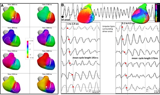 Rotational activity: serial images and acceleration during the initial seconds of ventricular fibrillation. (A) Patient with dilated cardiomyopathy and rotational activity in the right ventricle (total 12 rotations, the driver area in this patient, is shown in Figure 4B). Rotational activity is shown as full phase progression around a centre-point in colour-coded phases of wave propagation. The series of images show two full rotations (cycle length 150 ms) in colour-coded activation maps around a pivot point (asterisk in first and last image). (B) In another patient with dilated cardiomyopathy, rotational activities occurred in lateral left ventricle at the beginning of ventricular fibrillation (1–1.9 s) and one second later (3.1–4.3 s), in addition to other activities (not shown). The top trace shows a sample unipolar electrogram. Rotational activity is shown as full phase progression around a center-point in colour-coded phases of wave propagation. Coloured points indicate the sites where unipolar electrograms are recorded around the pivot point and show sequential activation (timing shown by red points). The mean local cycle length is 191 ms during the 1–1.9 s ventricular fibrillation interval and has decreased to 172 ms during the 3.1–4.3 s ventricular fibrillation interval.