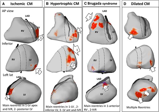 Main drivers during initial organized ventricular fibrillation. Epicardial views in anterior, inferior, and left lateral projections, showing driver distribution during the first 5 s after ventricular fibrillation initiation. The dotted lines depict the interventricular region (IVR—indicating septal projection) along the left anterior descending and interventricular coronary arteries. Rotational activities are shown in red areas. The numbers indicate the number of rotations at each area. Main drivers (as defined in the text) are indicated by white arrows. Note that drivers are present in interventricular region in all cases. CM, cardiomyopathy.