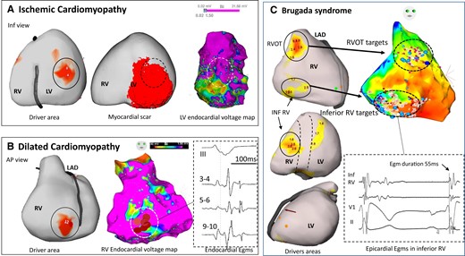 Driver locations in relation to substrate. In three patients, the locations of drivers are shown in relation to structural substrate defined on electrophysiological criteria or scar imaging. (A) A case of ischaemic cardiomyopathy with drivers (full circle) in the inferior left ventricle associated with myocardial infarction scar on magnetic resonance imaging (middle) and low voltage area on electrogram mapping (right). There is an overlapping of driver area with the substrate (dotted circle) defined on imaging or mapping technique. (B) A case of dilated cardiomyopathy with a right ventricle driver area (full circle) related to low voltage (middle) and fractionated and late electrograms (right). This patient had no scar in the right ventricle on magnetic resonance imaging. Note that the driver is located at the border of abnormal electrogram substrate. (C) A case of Brugada syndrome with drivers in the RV outflow tract and inferior right ventricle (left), overlapping with abnormal epicardial electrograms (right). After ablation at the RV outflow tract, ventricular fibrillation was still inducible by two extrastimuli with persistent drivers in the inferior right ventricle. Ablation at the inferior right ventricle resulted in ventricular fibrillation non-inducibility and no recurrence of ventricular fibrillation for 62 months. Note that inferior right ventricle displays mildly abnormal electrograms not fulfilling all abnormality criteria (electrogram duration is 55 ms instead of being >70 ms). The colours of driver areas are not uniform as different system versions have been used. AP, anteroposterior; LAD, left anterior descending coronary artery.