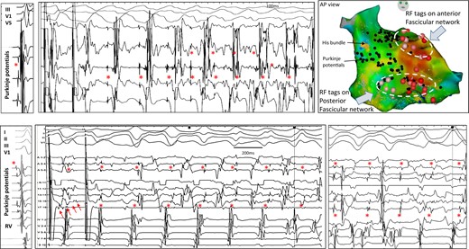 Inducible repetitive activity in distal Purkinje in hypertrophic cardiomyopathy. The upper panels show a recording in sinus rhythm and ventricular fibrillation induction with programmed stimulation in a 29-year-old man. A decapolar catheter along the distal fascicle indicates that each of the initial ventricular beats is associated with Purkinje activity (red asterisks); the latter has a more rapid cycle length (mean 219 ms) than the local ventricle (230 ms). The lower panels show a recording in sinus rhythm and ventricular fibrillation induction with programmed stimulation in a 63-year-old man. Ventricular fibrillation induction is associated with 1:1 Purkinje activity. The multispline catheter shows Purkinje activities on several bipoles (red asterisks); Purkinje cycle length (mean 237 ms) is shorter than local ventricular cycle lengths (252 ms). Another ventricular fibrillation window occurring 1 s later is also shown. Note that ventricular electrograms are significantly fractionated and disturb Purkinje recognition. This is clearly seen (five small arrows) in the last paced beat inducing ventricular fibrillation. In both patients, ventricular fibrillation was non-inducible after Purkinje ablation. The ablation lesions targeting the Purkinje arborization (red tags) are shown for the upper case. In both patients, the 12-lead electrocardiograms of ventricular fibrillation induction and voltage maps are shown in Supplementary material online, Figure S6.