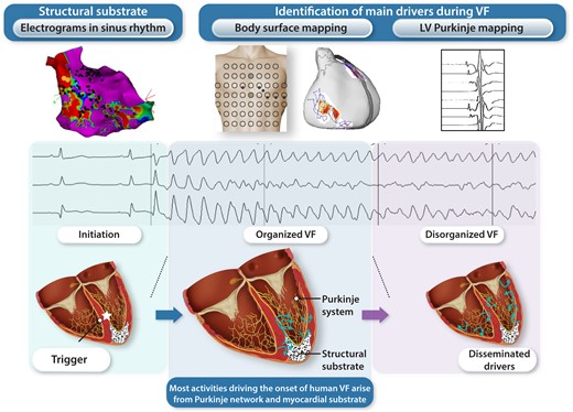 Ventricular fibrillation (VF) onset in humans—Purkinje and structural substrate govern the transition from trigger to disorganized VF. Schematic view of initial VF activities in patients with cardiac structural abnormalities. The upper panel shows an electrocardiogram of spontaneous VF onset in a patient with a prior history of myocardial infarction. The three illustrations show the sequence of trigger, initial organized VF, and disorganized VF. The trigger is shown as a red star close to the structural substrate (mottled white area). Initial VF activities are represented as localized waves generated from the ventricular or Purkinje substrate. Then the acceleration of activities in parallel with previously described changes (reduction in action potential duration, Ca handling…) leads to dissemination of activities and VF disorganization.