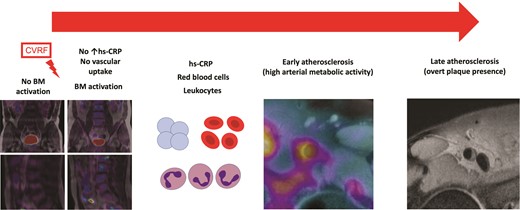 The hypothesis of the natural history of the inflammatory process involving atherosclerotic plaque formation. Bone marrow (BM) is implicated in the atherosclerotic process long before the appearance of acute cardiovascular events. Cardiovascular risk factors trigger BM activation, initially in the absence of systemic inflammation. As BM activation progresses, it is accompanied by an increase in haematopoietic progenitor cells and an associated increase in inflammatory markers. The next step in the process is arterial inflammation, leading to an increase in atherosclerotic burden.8 CVRF, cardiovascular risk factors; hs-CRP, high sensitivity C-reactive protein.