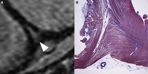 Validation of cardiac imaging findings in dilated cardiomyopathy with pulmonary hypertension. (A) Presence of late gadolinium enhancement in the right ventricular junctional insertion point of the interventricular septum (arrowhead). (B) At autopsy no scar is visible but a marked expansion of the interstitial space due to oedema in the context of disorderly arranged myocytes (modified from De Lazzari et al.24).