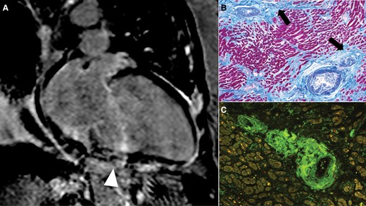 Unexpected histological findings in dilated cardiomyopathy with extensive cardiac imaging investigation during life. (A) Post-contrast cardiac magnetic resonance, two-chamber view: severe left ventricular dilatation and focal late gadolinium enhancement compatible with fibrosis (not coronary-related ischaemic pattern; arrowhead; courtesy of Professor Perazzolo Marra). (B) Histology of the myocardium shows patchy replacement-type fibrosis (arrows) and thickened wall of the small intra-myocardial vessels with lumen subocclusion. (C) Amyloid deposits in the vascular wall are confirmed by Congo red stain by fluorescent microscopy (apple-green birefringence).