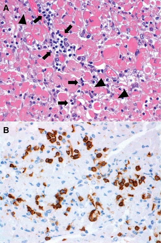 Immune checkpoint inhibitor-associated myocarditis treated with solumedrol and abatacept. Histology of the myocardium at autopsy confirms persistent high-grade myocarditis after treatment. (A) Haematoxylin and eosin-stained section showing infiltration of the myocardium by lymphocytes (arrows) and associated myocyte injury (arrowheads). (B) Immunohistochemical stain for the cytoxic T-cell marker CD8 shows numerous CD8+ lymphocytes.
