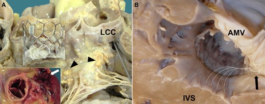 Peri-procedural complications in patients undergoing transcatheter aortic valve implantation. (A) Intra-operative aortic annulus rupture soon after the transcatheter aortic valve implantation procedure with cardiac tamponade (boxed area, external rupture in the pericardial cavity, arrow): in the left ventricular outflow tract region, note the topographic relationship between the bulky calcifications at the level of right and left fibrous trigone (arrowheads) and the rupture at the nadir of the left-coronary cusp (where the probe is passing through; modified from van Tarantini et al.47). (B) Deep implantation of the prosthesis in the left ventricular outflow tract causes compression of subaortic septum, where the specialized conduction system (left bundle branch, white dotted lines) runs superficially with increased incidence of iatrogenic atrioventricular block (arrow indicates atrioventricular node, modified from Fraccaro et al.48). LCC, left-coronary cusp; IVS, interventricular septum; AMV, anterior leaflet of the mitral valve.