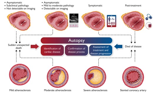 Clinical role of autopsy in patients who die unexpectedly or of known cardiac disease: identification of cardiac disease; confirmation of cardiac disease; and assessment of treatment and disease progression. Top: myocardial disease. Stage 1: Asymptomatic, subclinical (not detectable by current imaging, but detectable at autopsy). Stage 2: Asymptomatic, mildly dilated (detectable by imaging and at autopsy). Stage 3: Symptomatic, dilated (detectable by imaging, confirmed at autopsy). Stage 4: Symptomatic, dilated, post-treatment (assessment of therapy, verification of diagnosis). Bottom: coronary artery disease. Stage 1: Asymptomatic, mild atherosclerosis, complicated by acute thrombosis. Stage 2: Asymptomatic, moderate atherosclerosis, complicated by thrombosis. Stage 3: Symptomatic, severe atherosclerosis. Stage 4: Symptomatic, atherosclerosis post treatment (stent), complicated by thrombosis.