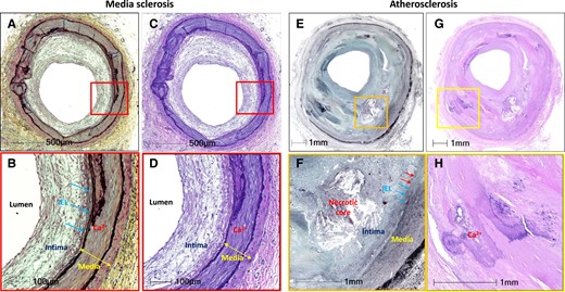 Comparison of media sclerosis and atherosclerosis. Low-power (A and C) and high-power (B and D) images of popliteal artery showing Monkeberg's medial sclerosis. Note presence of Grade IV (i.e., circumferential) medial calcification. Intimal thickening is seen (B and D) without atherosclerosis. The internal elastic lamina (IEL) is intact as demonstrated in B (blue arrows). Low-power (E and G) and high-power (F and H) images are the superficial femoral artery showing atherosclerosis. A necrotic core and IEL disruption is observed (F, red arrows) (blue arrows show intact IEL). Fragments of calcification (Ca++) are also present in the intima (H). Images A, B, E, and F are stained with Movat pentachrome. Images C, D, G, and H are stained with haematoxylin and eosin.
