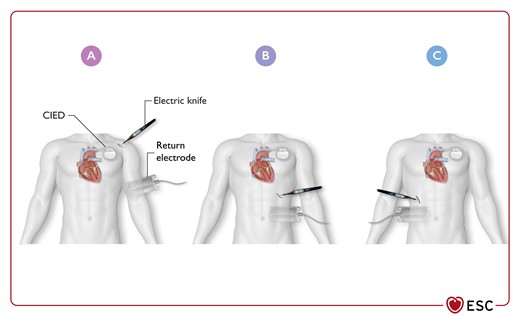 Optimal location of return electrode during unipolar electrosurgery in patients with cardiac implantable electronic devices, depending on the surgery site.