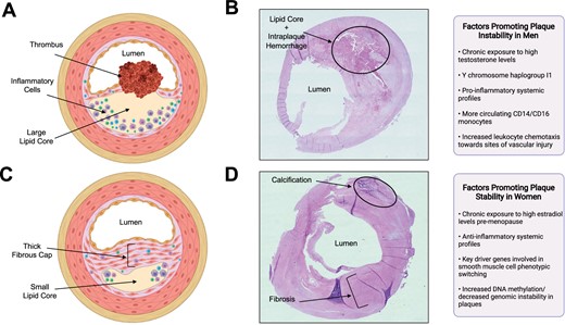 Differences in plaque morphology and composition between male vs. female carotid atherosclerotic plaque specimens and associated factors contributing to the pathologies. (A). A drawing illustrating a typical plaque isolated from men (unstable plaque), which includes a large lipid core, a thin ruptured fibrous cap, abundant inflammatory cells, and thrombus formation. Created with BioRender.com. (B) Representative photomicrograph of haematoxylin and eosin-stained carotid plaque obtained from a symptomatic man who underwent a carotid endarterectomy at the McGill University Health Centre, Montreal, Canada. The plaque exhibits unstable features; a large lipid core, intraplaque haemorrhage, and a thin fibrous cap. Image photographed at magnification ×20. (C) A drawing illustrating a typical plaque isolated from women (stable plaque), which includes a smaller lipid core, and thick intact fibrous cap. Created with BioRender.com. (D) Representative photomicrograph of haematoxylin and eosin-stained carotid plaque obtained from a symptomatic woman who underwent a carotid endarterectomy at the McGill University Health Centre, Montreal, Canada. The plaque exhibits stable features; composed mainly of fibrous tissue and calcification and has no apparent lipid core. Image photographed at magnification ×20.