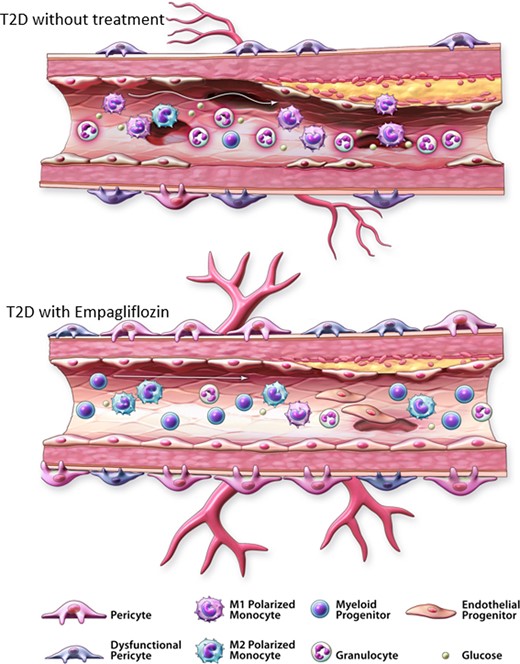 Reversal of circulating progenitor cell imbalance associated with type 2 diabetes. Circulating progenitor cell imbalance is characterized by increased pro-inflammatory progenitor cells and the depletion of pro-angiogenic haematopoietic and monocytes in the peripheral blood. (A) In individuals with type 2 diabetes, increased circulating ALDHhiSSChi granulocyte precursors and increased ALDHhiSSCmid monocytes with M1 polarization contribute to elevated systemic inflammation associated with endothelial dysfunction. Reduced circulating ALDHhiSSClow cells with pro-angiogenic secretory capacity will interfere with the repair of damaged vessels. After administration of the SGLT2i empagliflozin, decreased circulating ALDHhiSSChi granulocyte content alongside improved ALDHhiSSCmid monocyte balance will reduce systemic inflammation. Increased circulating ALDHhiSSClow cells with CD34/CD133 co-expression will promote vessel repair.