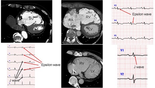 Abstract Figure. CT and ECG in ARVC