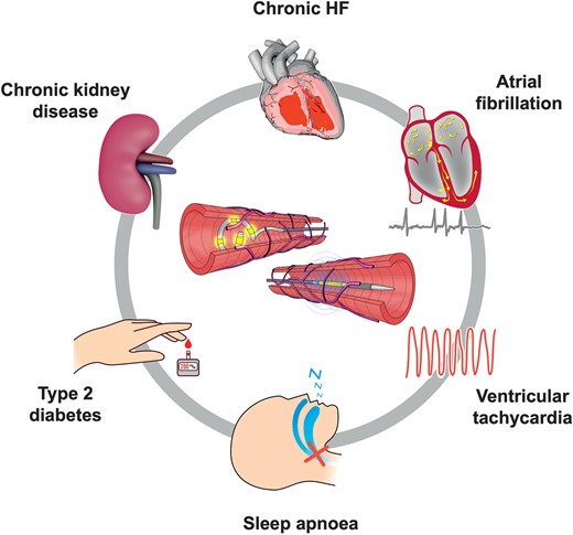 Potential future indications for RDN beyond hypertension (currently under investigation). HF: heart failure; RDN: renal denervation