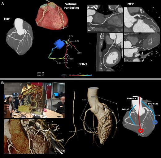 XR-integrated clinical workflow in coronary artery bypass surgery: (A) shows that for patients with coronary artery disease, we can use non-invasive anatomic and functional CTA as the sole guide for planning revascularization.29 CTA = computed tomography angiogram, FFRct = CT derived functional flow reserve, MIP = maximal intensity projection, MPP = multi-planer projection. (B) shows the XR-integrated heart team discussion with direct graft length measurement in XR and the surgical plan. LIMA = left internal mammary artery, SVG = saphenous vein graft. (C) shows side-by-side the CTA analysis, the 3D hologram for visualization and manipulation during the procedure, and the actual surgical view of a different example case D1 = first diagonal branch, LIMA = left internal mammary artery, OM = obtuse marginal branch, LAD = left anterior descending artery, RA = radial artery graft. Picture courtesy of Dr. Fabio Ramponi and Dr. John Puskas. (D) shows the post-operative review at 30-day follow-up with the anatomical and functional assessment showing that an SVG was inappropriately attached to segment 2. The 3D model shows that the unsatisfactory result could have been avoided by using the RIMA for RCA. A 3D printing model was also created for direct assessment. LIMA = left internal mammary artery, SVG = saphenous vein graft, RIMA = right internal mammary artery.