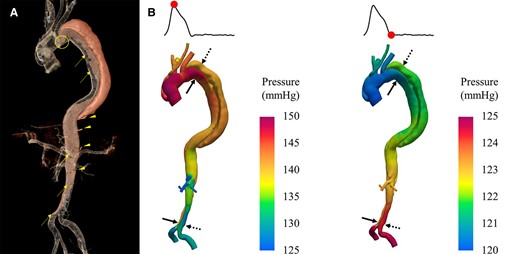 Three-dimensional model of aortic dissection constructed from CT images showing anatomical details and pressure distribution: panel A shows the detailed anatomical 3D model of the aortic dissection false lumen overlayed on the true lumen. This model shows the entry sites (circle), the re-entry sites (arrows), and the spinal arteries connected to the false lumen (arrowheads). Panel B shows the distribution of pressure at mid-systole (Left) and early diastole (Right).