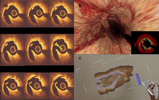 An example of intraprocedural OCT reconstruction and visualization using MxR technology: panel A shows the post-balloon dilatation OCT run-through where a concerning flying object was noted (arrow). Panel B shows the 3D reconstruction of the OCT images, which revealed that the flying object was, in fact, a floating band. Panel C shows the interventionist’s view of the reconstructed 3D images in MxR with the floating band in sight. OCT = optical coherent tomography.