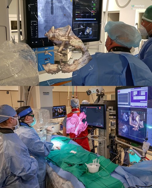 Intraprocedural use of MxR: panel A shows real-time 3D trans-esophageal echocardiography visualization during an atrial septal defect closure with HoloLens mixed reality goggles. The data was streamed to the operator, who can control the volume rendering independent of the echocardiographer. Panel B shows real-time 3D trans-oesophageal echocardiography visualized on the EchoPixel platform. Courtesy of MedApp (Krakow, Poland).